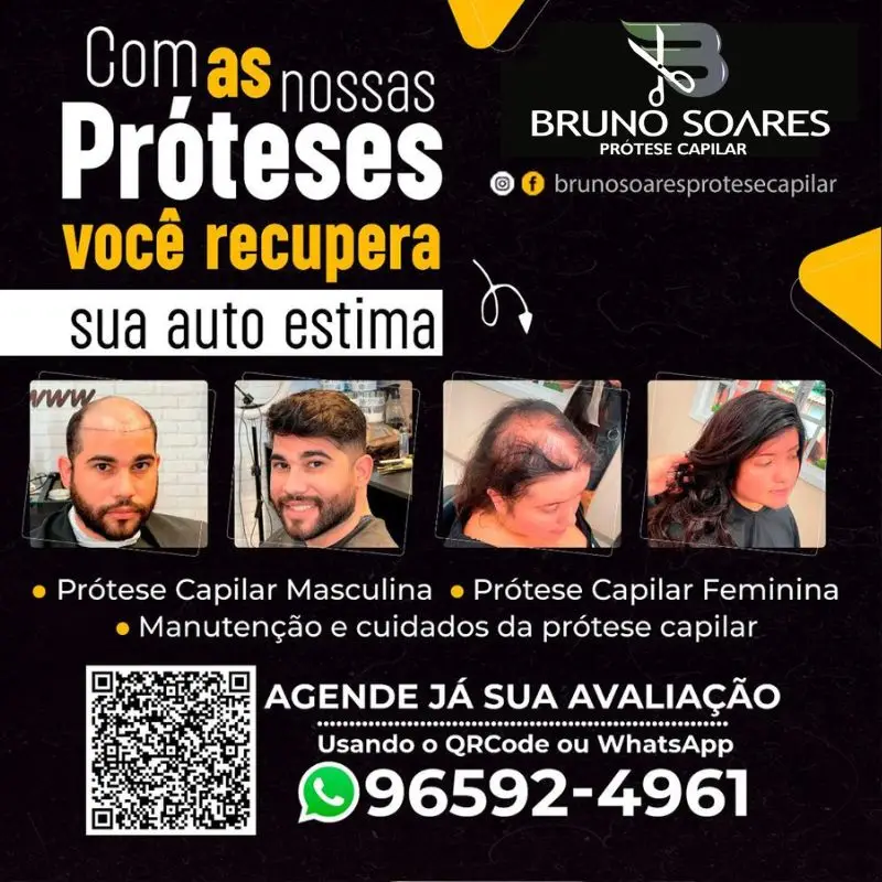 Imagem ilustrativa de Protese capilar masculina no brasil